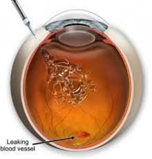 Inyeccion de esteroides en el ojo