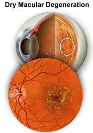 Dry Macular Degeneration